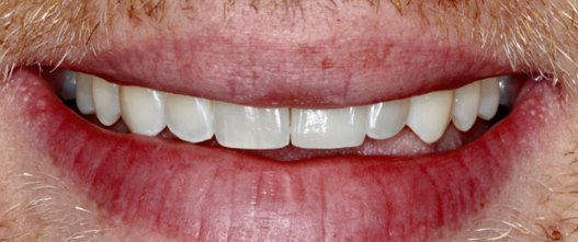 After: Missing front tooth replaced with an implant and crown