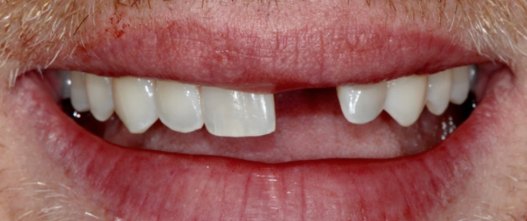 Before: Missing front tooth replaced with an implant and crown