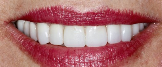 After: Chipped, uneven teeth restored and the bite recalibrated