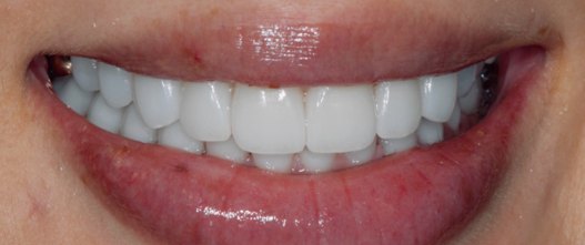 After: Full mouth reconstruction with zirconia crowns on all teeth