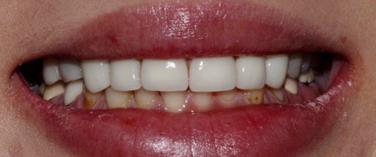 Before: Full mouth reconstruction with zirconia crowns on all teeth