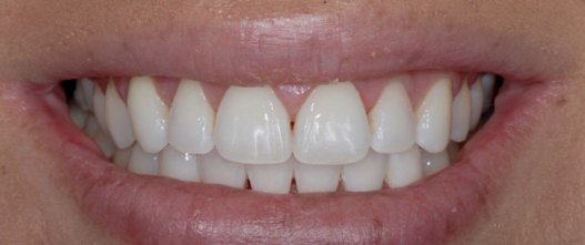 After: Crowding corrected with Invisalign clear aligners