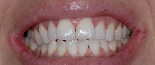 Before: Crowding corrected with Invisalign clear aligners