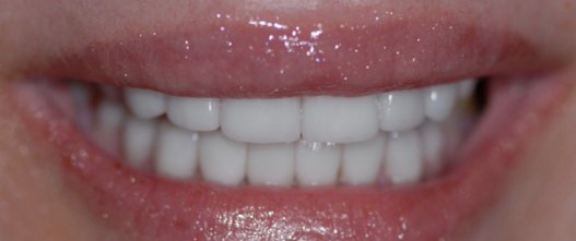 After: Full mouth rejuvenation with minimally invasive porcelain veneers