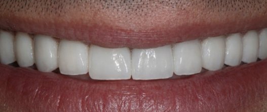 After: 10 custom porcelain veneers over worn, discolored teeth