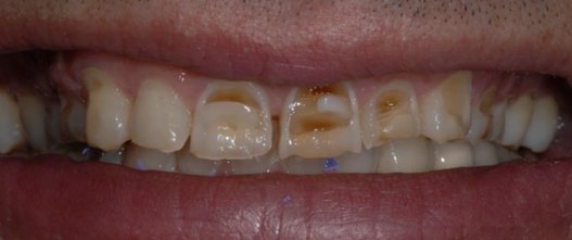 Before: 10 custom porcelain veneers over worn, discolored teeth