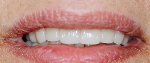 After: 10 upper porcelain veneers