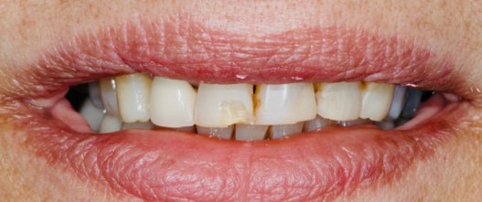 Before: 10 upper porcelain veneers