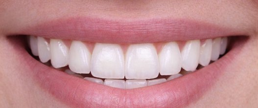 After: 10 upper and 10 lower porcelain veneers