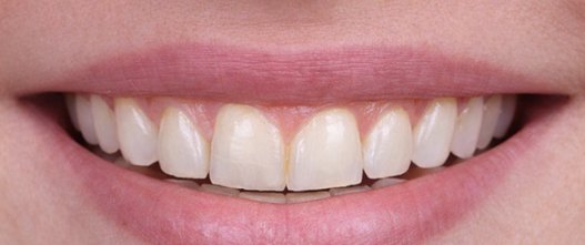 Before: 10 upper and 10 lower porcelain veneers
