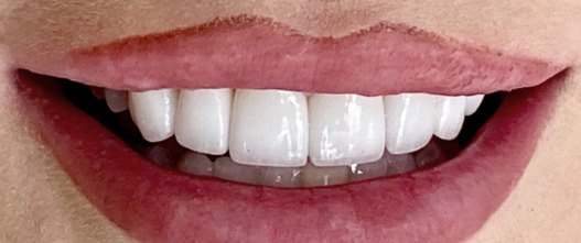 After: 6 porcelain veneers