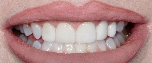 Before: 6 porcelain veneers