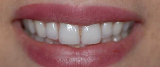 Before: 6 upper porcelain veneers