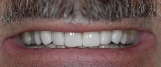 After: 8 upper porcelain veneers
