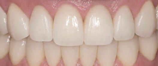 After: Upper and lower veneers replacing mismatched front crowns