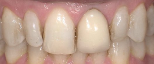 Before: Upper and lower veneers replacing mismatched front crowns