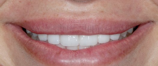 After: 10 upper zirconia crowns to correct the bite and raise the smile line
