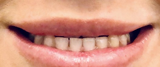 Before: 10 upper zirconia crowns to correct the bite and raise the smile line