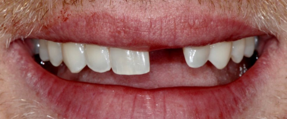 Before: a missing upper front tooth